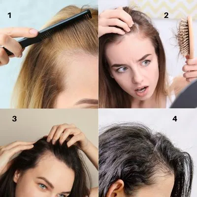 Female hair loss type 1