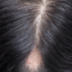 Alopecia-Areata
