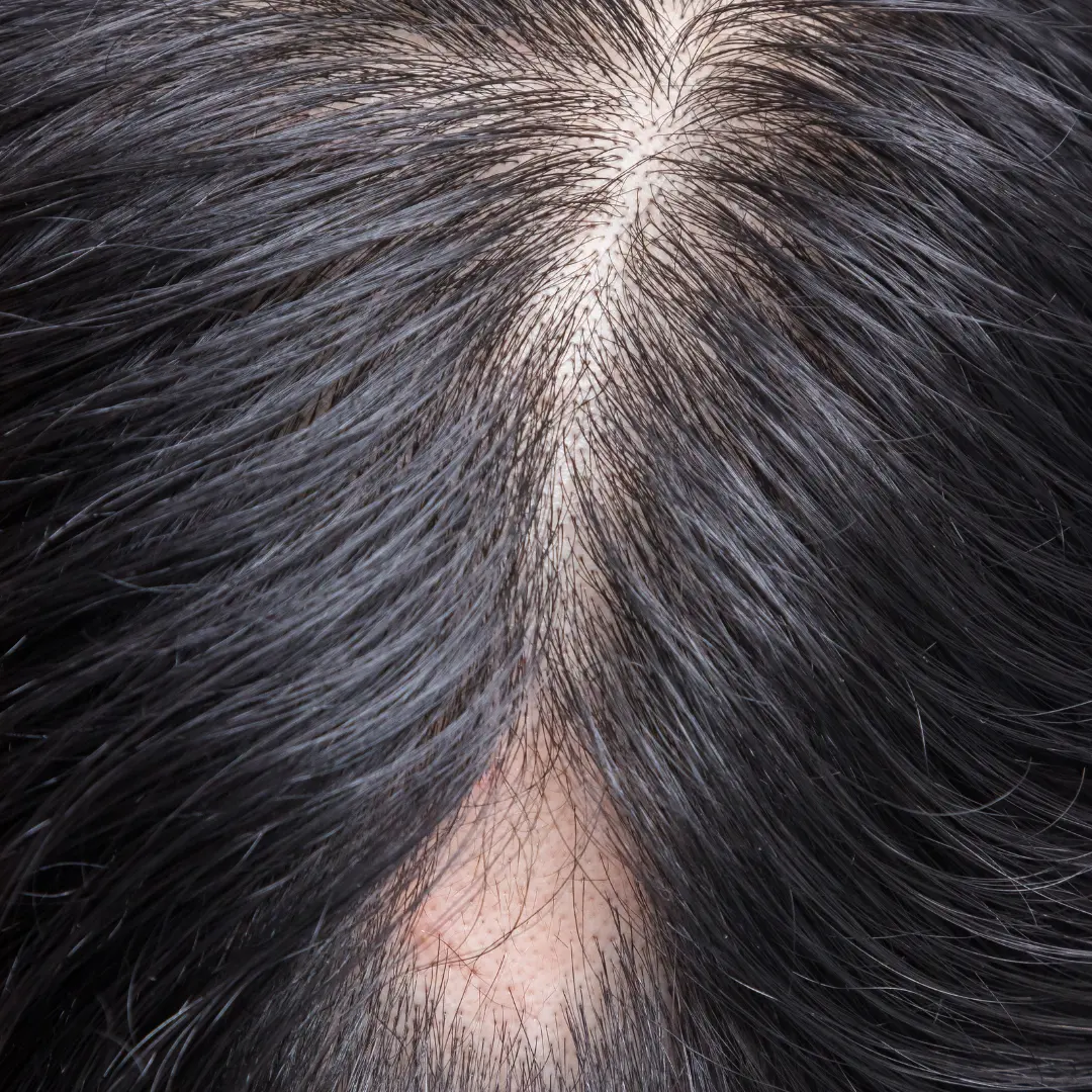 How to Stop Alopecia Areata from Spreading: Ultimate Guide -GeneHabit