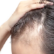 can androgenic alopecia be reversed