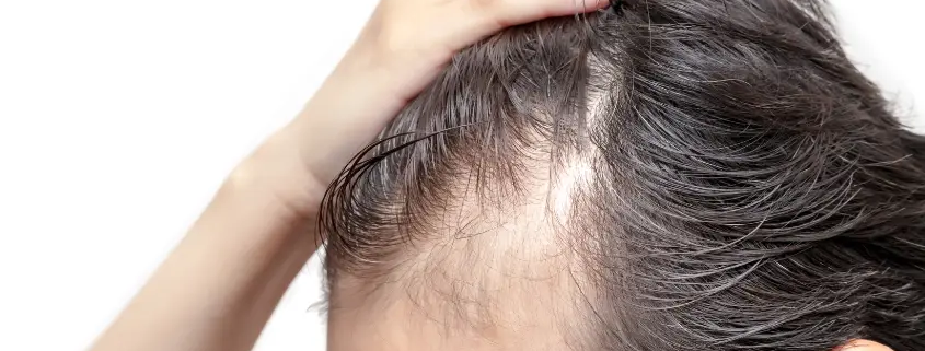 can androgenic alopecia be reversed