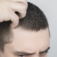 minoxidil-itchy-scalp