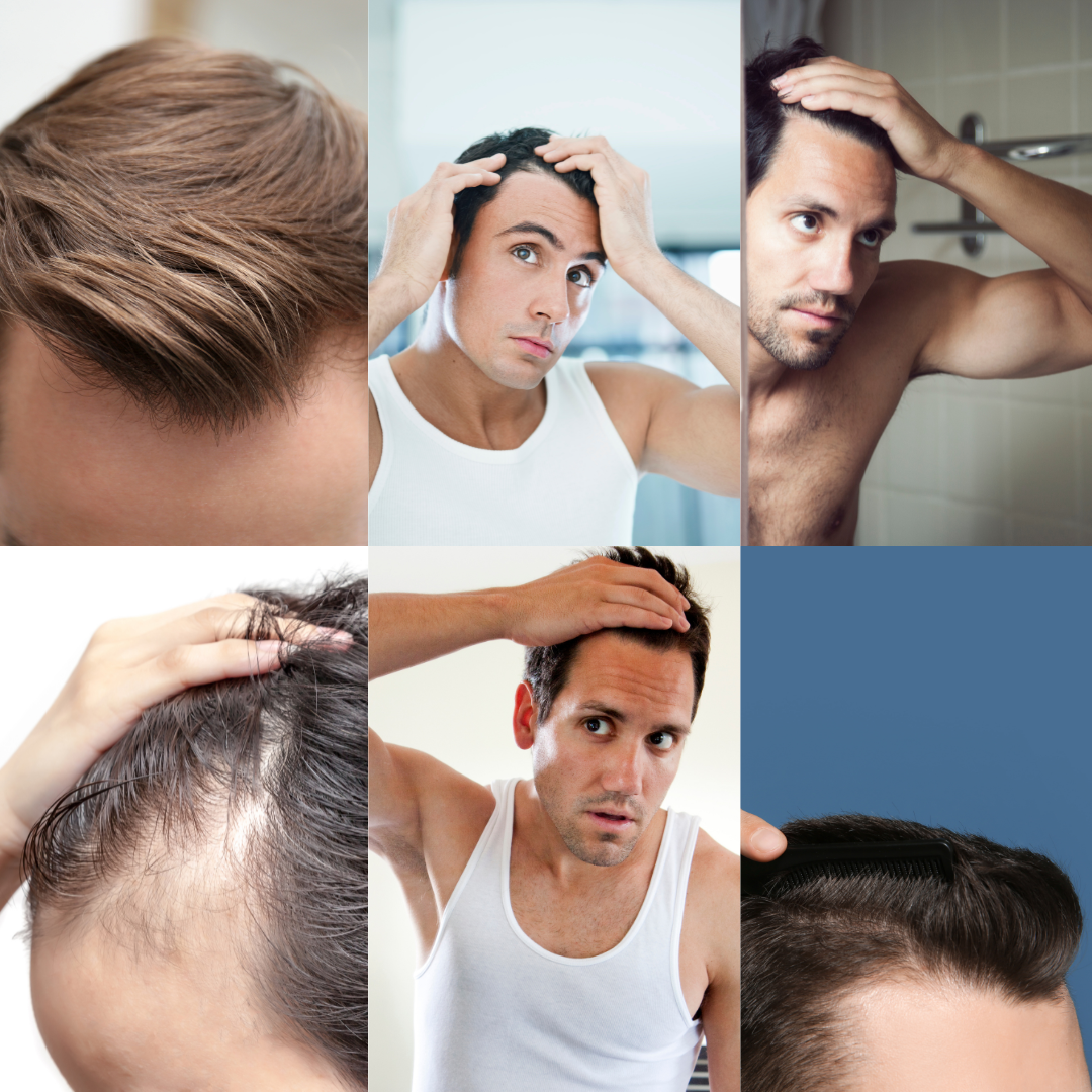 types-of-hairlines